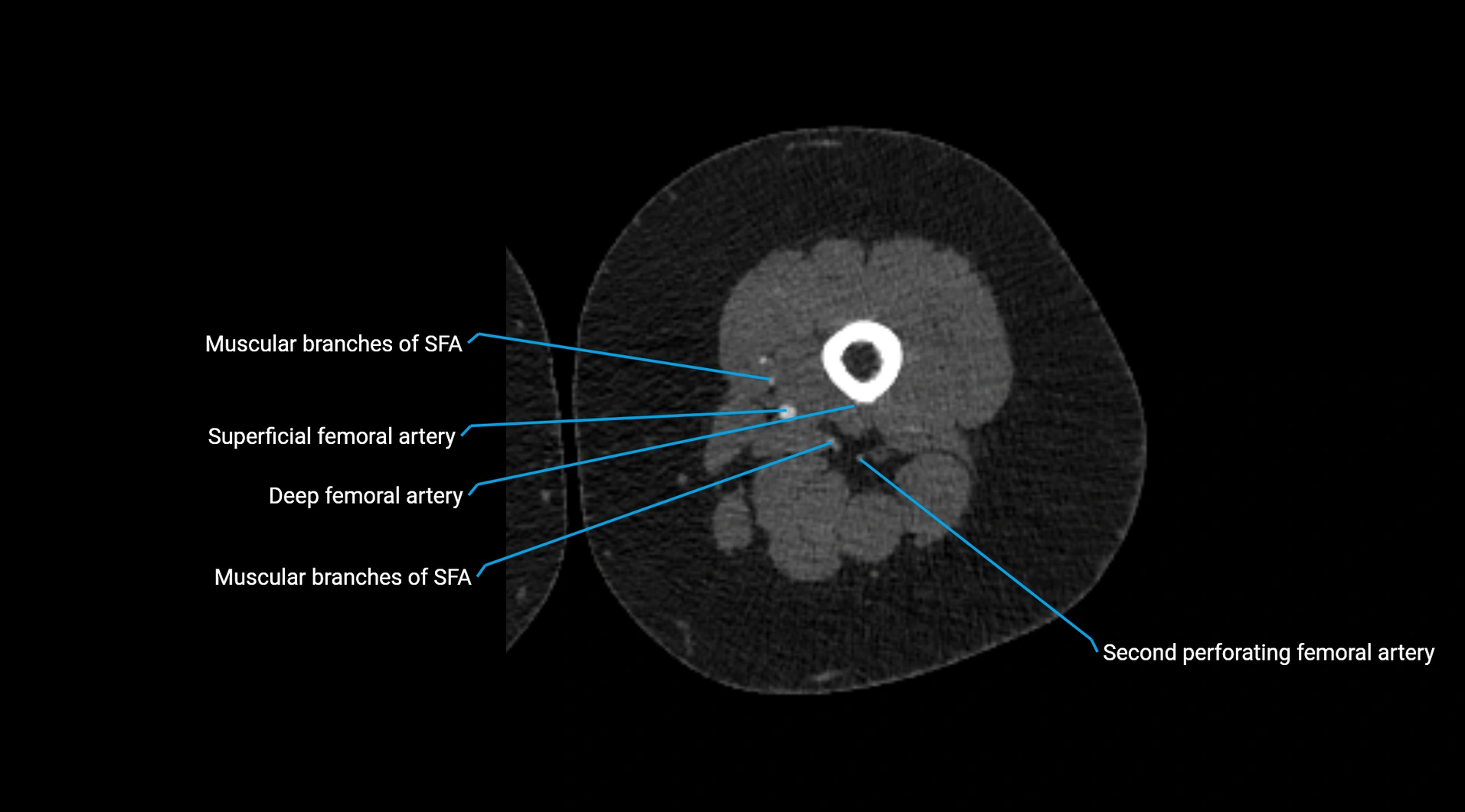 CTA lower limb cross sectional anatomy labelled image _136.webp